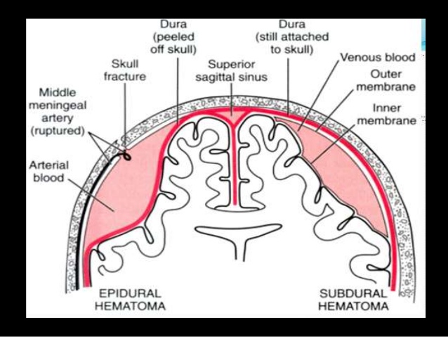 Subdural hematoma vs intracranial hemorrhage